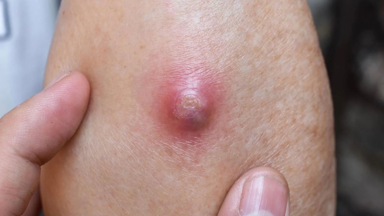 Ayurveda Medicine for Quick Relief from Boils